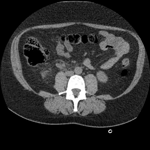 File:Acute cholecystitis and ureteric colic (Radiopaedia 42330-45444 Axial prone 57).jpg
