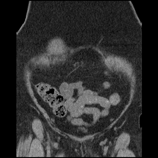 Acute cholecystitis and ureteric colic (Radiopaedia 42330-45444 Coronal prone 24).jpg