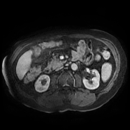 File:Acute cholecystitis complicated by pylephlebitis (Radiopaedia 65782-74915 Axial arterioportal phase T1 C+ fat sat 86).jpg