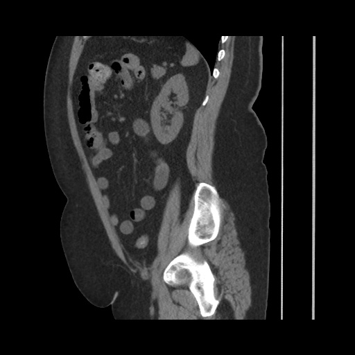 Acute cholecystitis with tensile fundus sign (Radiopaedia 71394-81723 Sagittal non-contrast 115).jpg