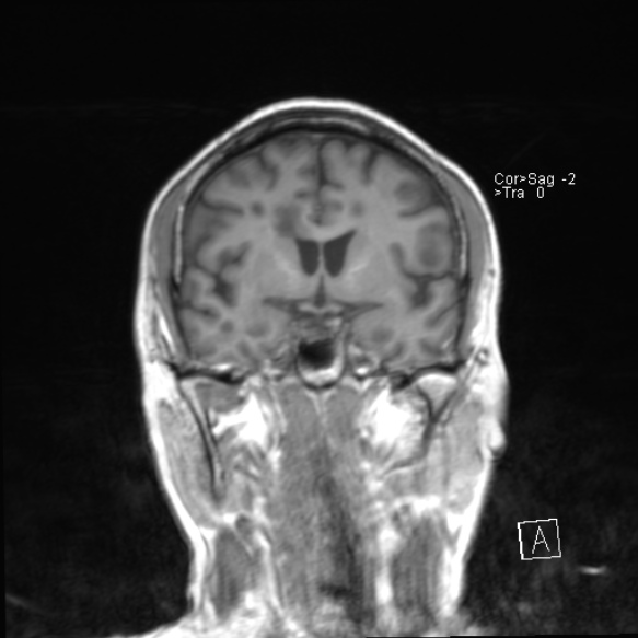 File:Acute disseminated encephalomyelitis (Radiopaedia 37253-39033 Coronal T1 12).jpg