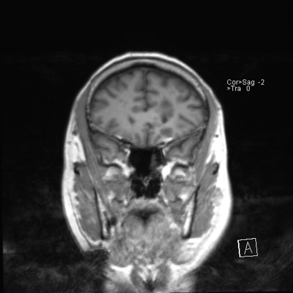 File:Acute disseminated encephalomyelitis (Radiopaedia 37253-39033 Coronal T1 9).jpg