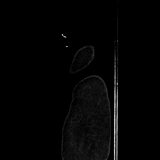 Acute diverticulitis - transverse colon (Radiopaedia 87063-103327 Sagittal C+ portal venous phase 230).jpg