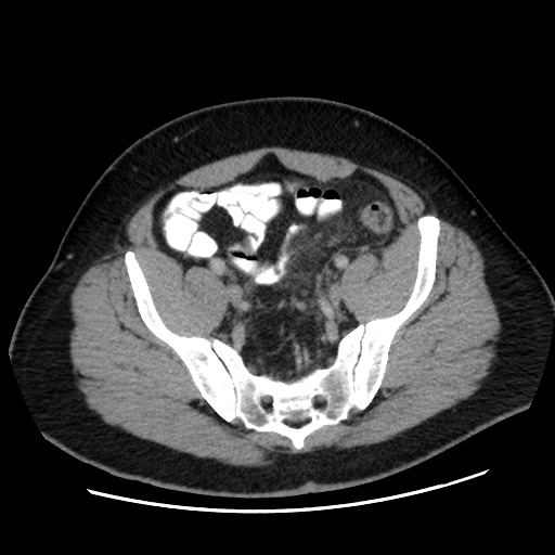 Acute diverticulitis with localized perforation (Radiopaedia 41296-44113 Axial C+ portal venous phase 72).jpg