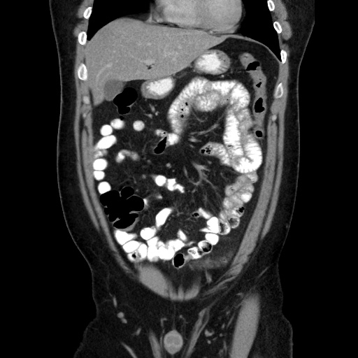 Acute diverticulitis with localized perforation (Radiopaedia 41296-44113 Coronal C+ portal venous phase 23).jpg