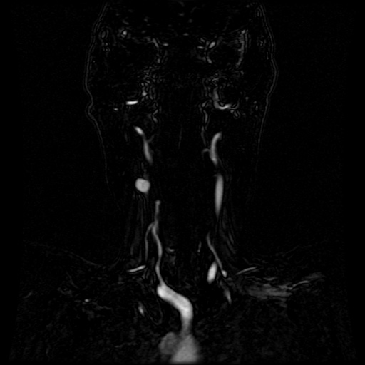 Acute internal carotid artery dissection (Radiopaedia 53541-59632 Coronal MRA 62).jpg