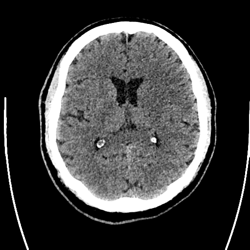 File:Acute left middle cerebral artery territory ischemic stroke (Radiopaedia 35688-37223 Axial non-contrast 44).png