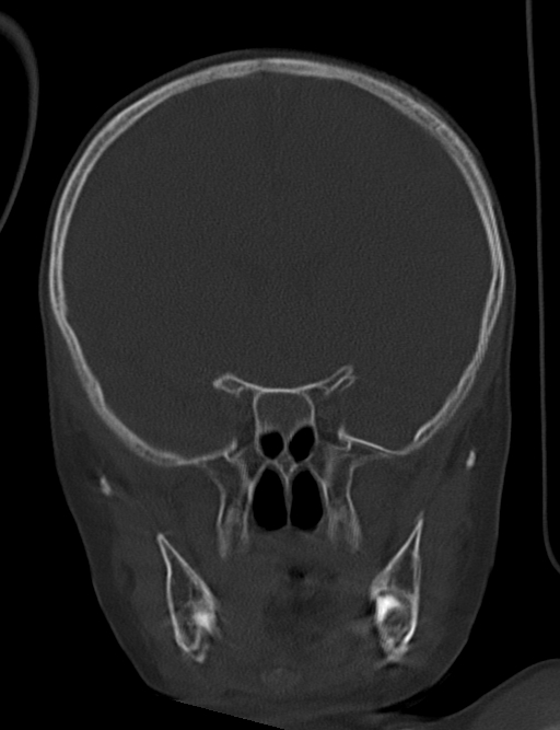 Acute mastoiditis (Radiopaedia 82678-96881 Coronal bone window 27).jpg