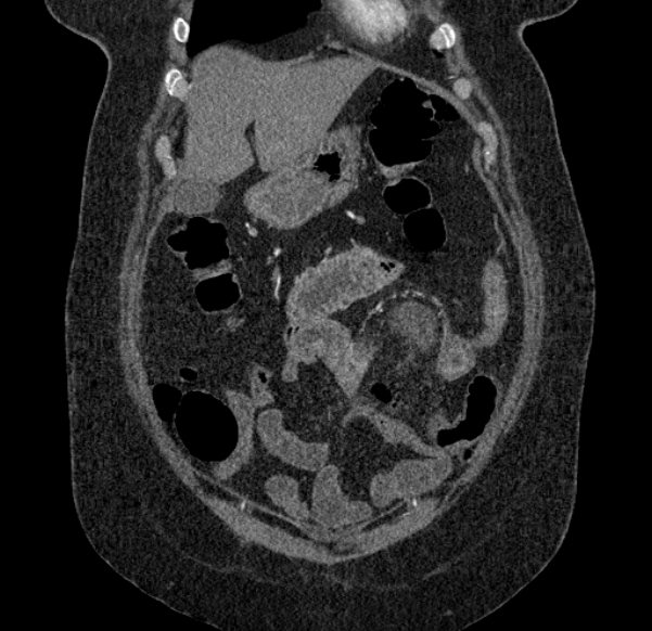 Acute mesenteric ischemia (Radiopaedia 80029-93316 Coronal C+ arterial phase 26).jpg