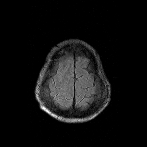 File:Acute necrotizing toxoplasma encephalitis (Radiopaedia 10683-11149 Axial FLAIR 2).jpg