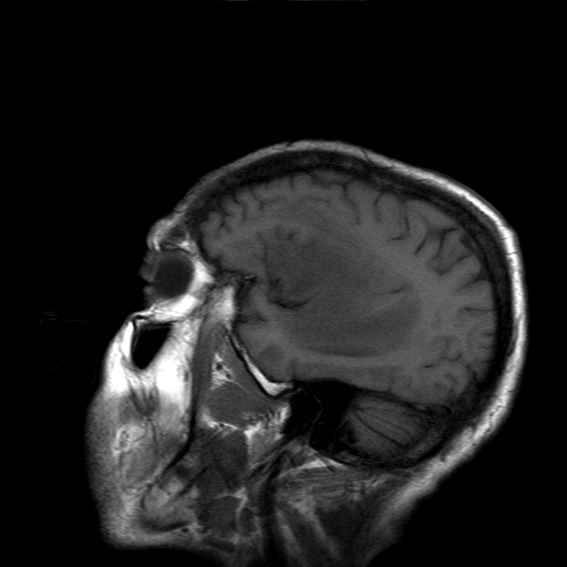 File:Acute necrotizing toxoplasma encephalitis (Radiopaedia 10683-11149 Sagittal T1 fat sat 4).jpg