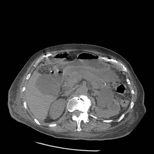 Acute on chronic pancreatitis (Radiopaedia 13233-13244 Axial non-contrast 32).jpg