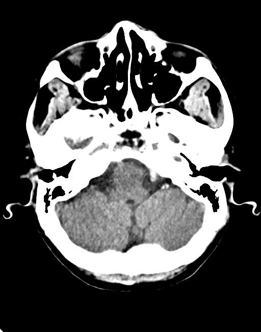 Acute on chronic subdural hematoma (Radiopaedia 74814-85823 Axial non-contrast 31).jpg
