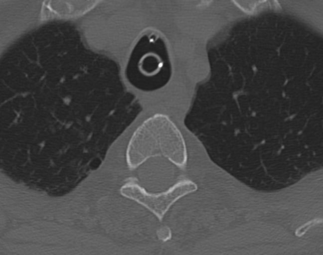 Acute on chronic subdural hematoma and thoracic vertebral injury in a multitrauma patient (Radiopaedia 31698-32619 Axial bone window 67).jpg