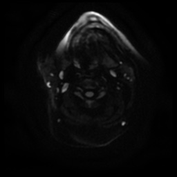 Acute otitis externa (Radiopaedia 57296-64236 Axial DWI 17).jpg