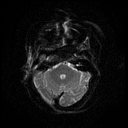Acute otitis externa (Radiopaedia 57296-64236 Axial DWI 35).jpg