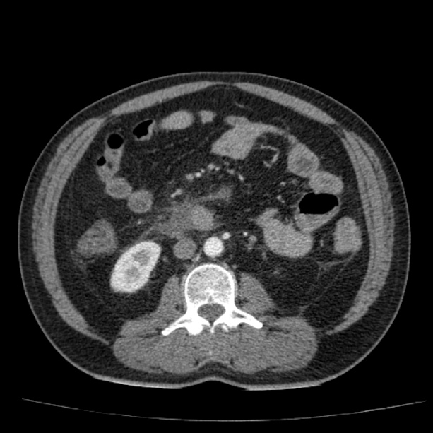 Acute pancreatitis (Radiopaedia 26663-26813 Axial C+ arterial phase 54).jpg