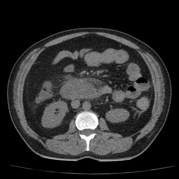 Acute pancreatitis (Radiopaedia 26663-26813 Axial non-contrast 49).jpg