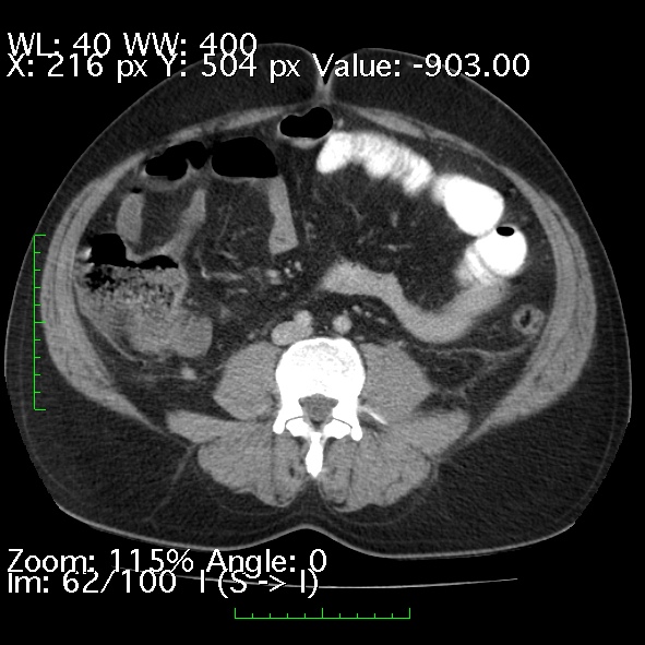 Acute pancreatitis (Radiopaedia 34043-35276 Axial C+ portal venous phase 62).jpg