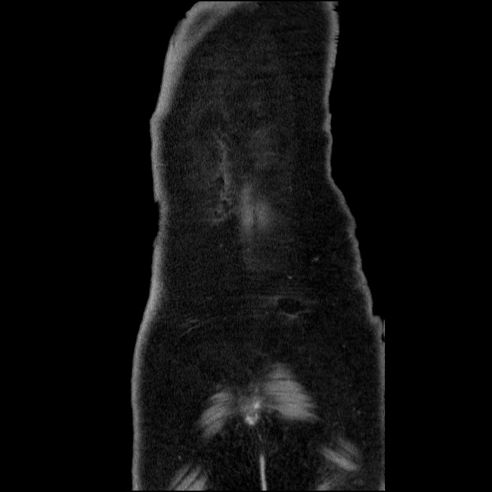 Acute pancreatitis (Radiopaedia 69236-79012 Coronal C+ portal venous phase 12).jpg