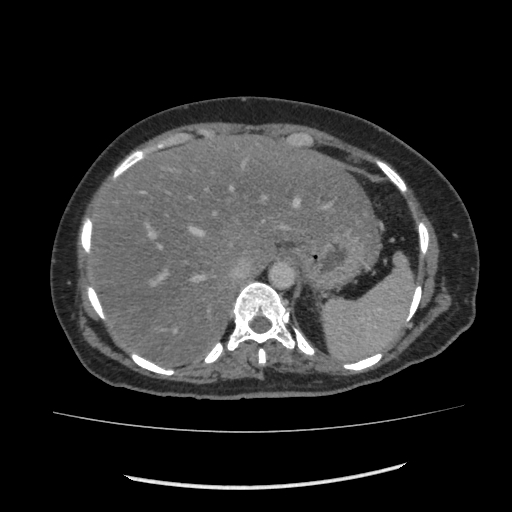 Acute pancreatitis (Radiopaedia 80007-93285 Axial C+ portal venous phase 26).jpg
