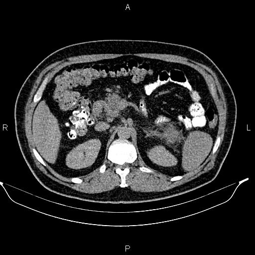 Acute pancreatitis (Radiopaedia 85390-101010 Axial C+ delayed 26).jpg