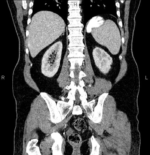 Acute pancreatitis (Radiopaedia 85390-101010 Coronal C+ portal venous phase 54).jpg