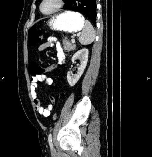 File:Acute pancreatitis (Radiopaedia 85390-101010 Sagittal C+ portal venous phase 76).jpg