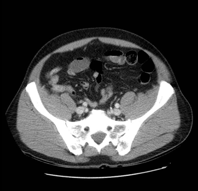 Acute pancreatitis - Balthazar E (Radiopaedia 23080-23110 Axial C+ portal venous phase 55).jpg