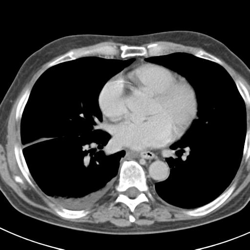 Acute pancreatitis and walled-off necrosis (Radiopaedia 29888-30403 Axial C+ delayed 2).jpg