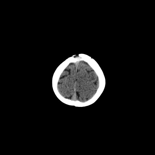 Acute phase of hemiconvulsion-hemiplegia epilepsy syndrome (Radiopaedia 29309-29744 Axial non-contrast 6).jpg