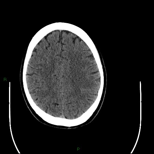 Acute posterior cerebral artery territory infarct (Radiopaedia 79329-92393 Axial non-contrast 78).jpg