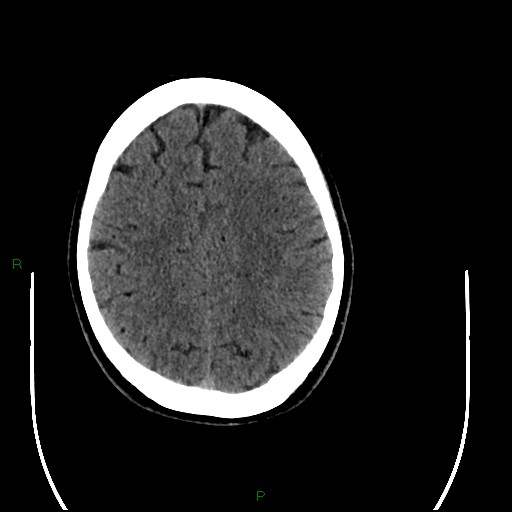 Acute posterior cerebral artery territory infarct (Radiopaedia 79329-92393 Axial non-contrast 80).jpg