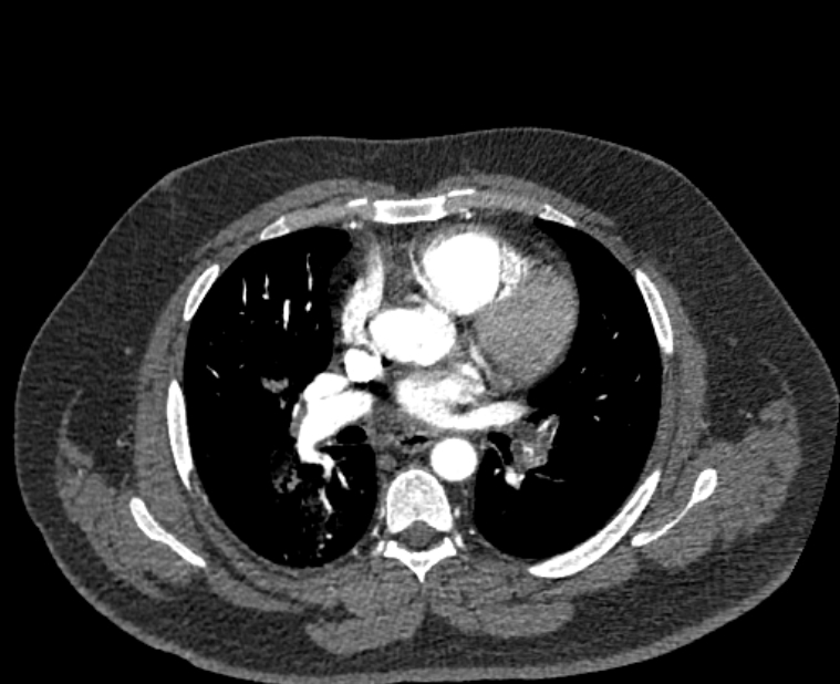Acute pulmonary embolism with pulmonary infarcts (Radiopaedia 77688-89908 Axial C+ CTPA 31).jpg
