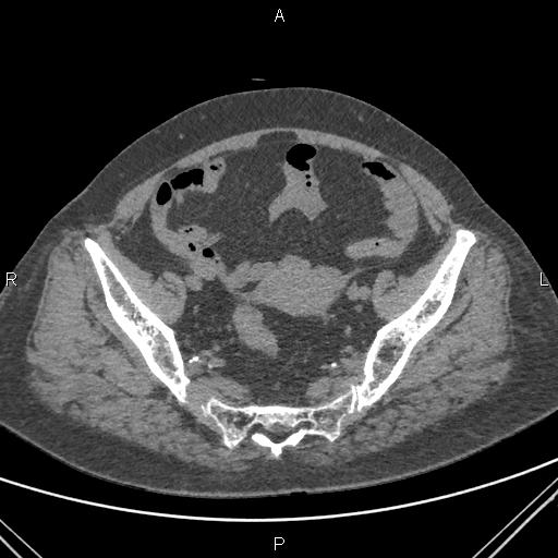 Acute renal artery occlusion (Radiopaedia 86586-102682 Axial non-contrast 76).jpg