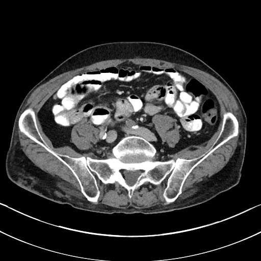 Acute renal infarction - rim capsular enhancement (Radiopaedia 59833-67270 Axial C+ portal venous phase 67).jpg