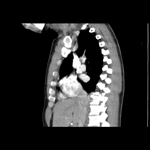 Acute segmental pulmonary emboli and pulmonary infarction (Radiopaedia 62264-70444 Sagittal C+ CTPA 29).jpg