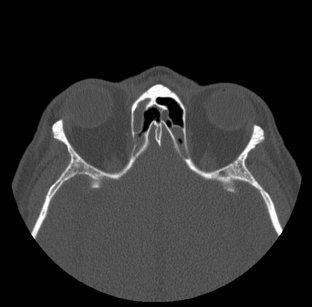 Acute sinusitis (Radiopaedia 23161-23215 Axial bone window 55).jpg