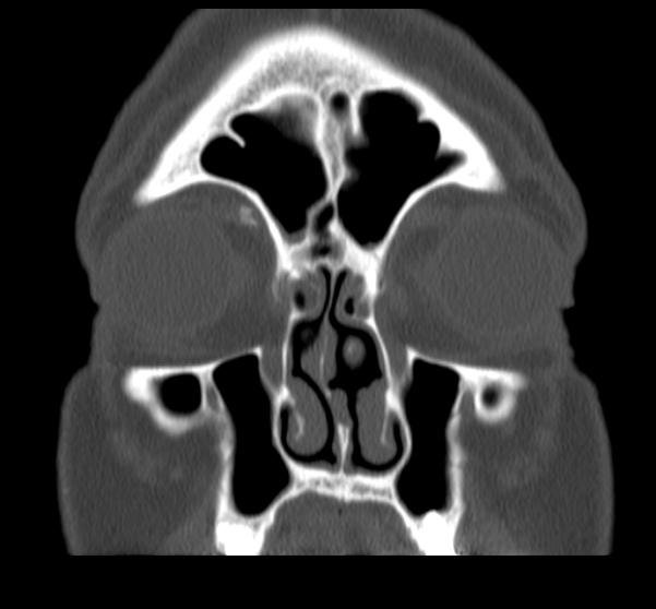 Acute sinusitis (Radiopaedia 23161-23215 Coronal bone window 25).jpg