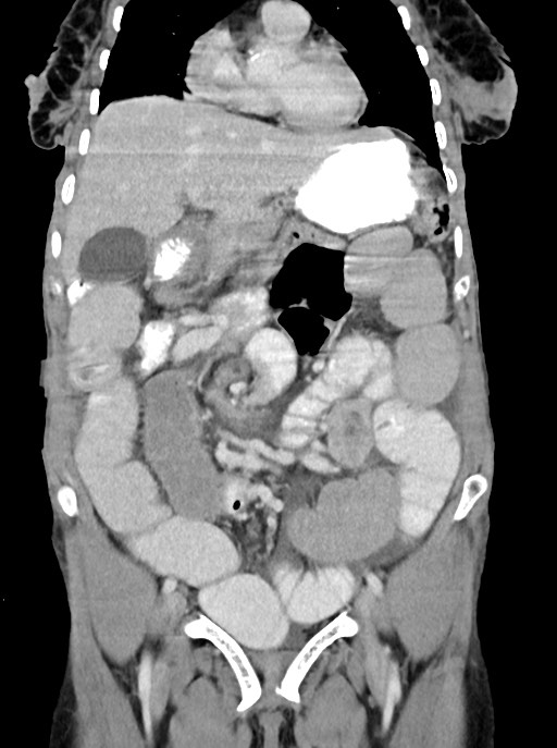 Acute small bowel (ileal) volvulus (Radiopaedia 71740-82139 Coronal C+ portal venous phase 43).jpg