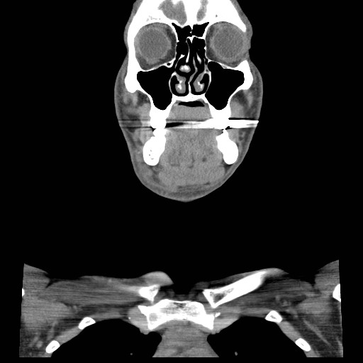File:Acute submandibular sialadenitis secondary to ductal stone (Radiopaedia 27999-28267 Coronal C+ delayed 18).jpg