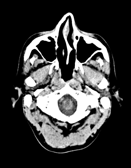 Acute superior cerebellar artery territory infarct (Radiopaedia 84104-99359 Axial non-contrast 61).jpg