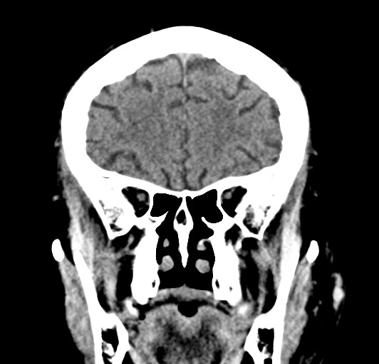 File:Acute traumatic subdural hematoma (Radiopaedia 82921-97257 Coronal non-contrast 32).jpg