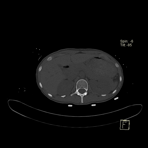 File:Acute vertebral compression fracture (Radiopaedia 63832-72559 Axial bone window 1).jpg