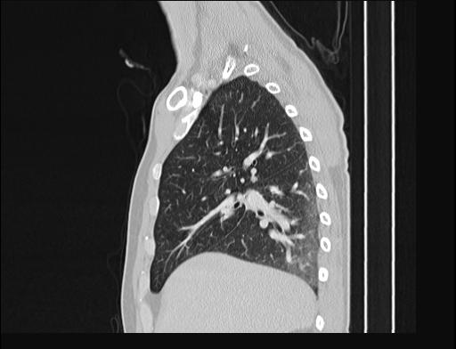 File:Addison disease (Radiopaedia 49318-54412 Sagittal lung window 44).jpg