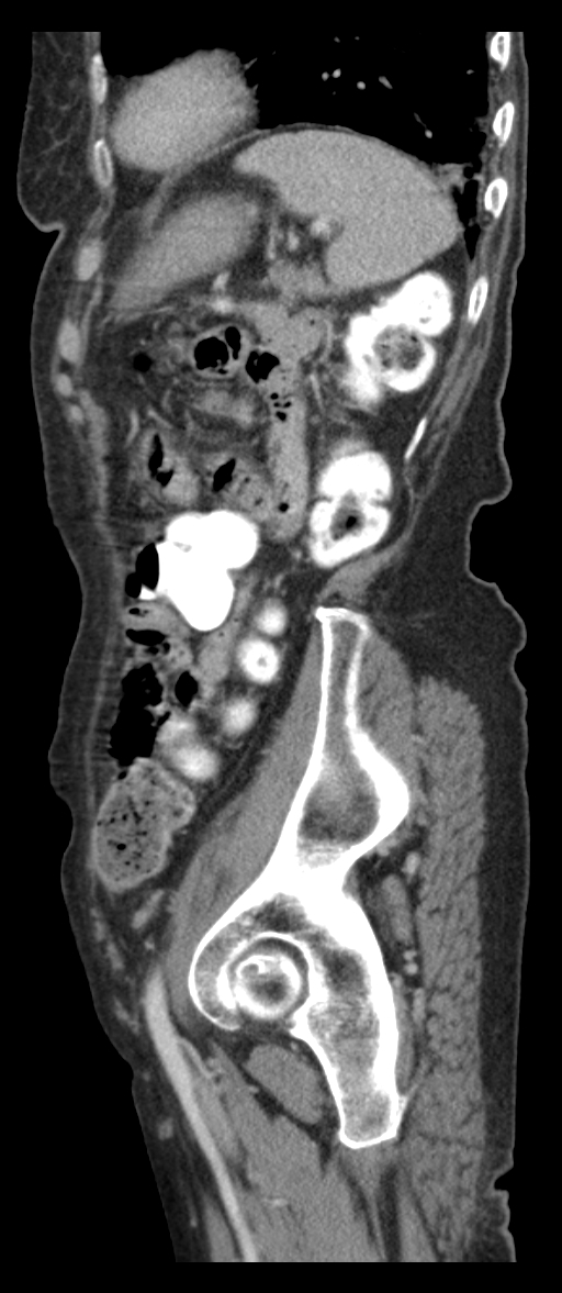 Adenocarcinoma of cecum (Radiopaedia 59222-66549 Sagittal C+ portal venous phase 15).jpg