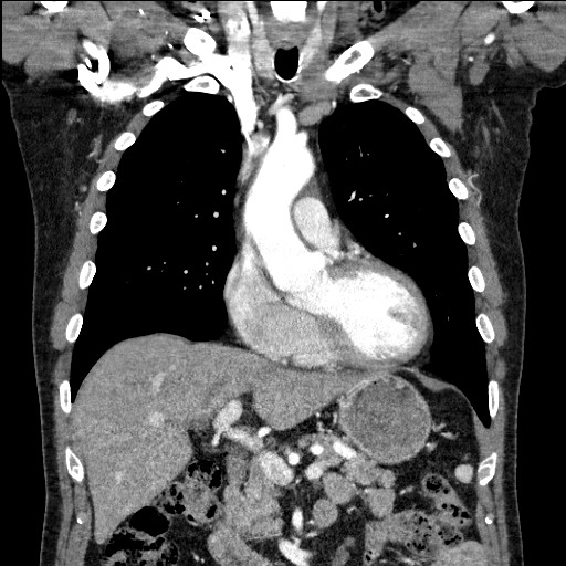 Adenocarcinoma of the lung (Radiopaedia 59871-67325 Coronal C+ arterial phase 25).jpg