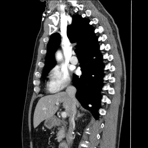 Adenocarcinoma of the lung (Radiopaedia 59871-67325 Sagittal C+ arterial phase 42).jpg