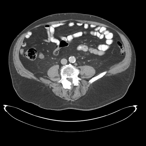 File:Adenocarcioma of rectum- T1 lesion (Radiopaedia 36921-38547 Axial C+ portal venous phase 54).png