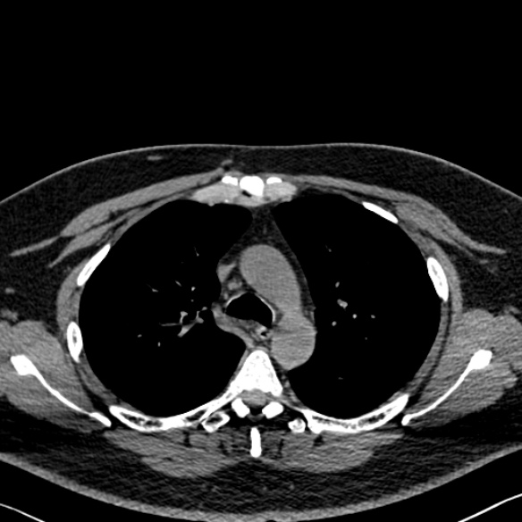 Adenoid cystic carcinoma of the trachea (Radiopaedia 49042-54137 Axial non-contrast 108).jpg
